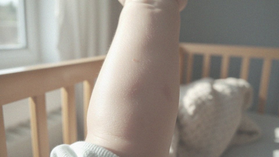 Alergia pokarmowa u niemowląt – objawy skórne, które warto znać